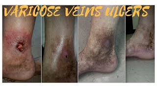 Best Treatments for Varicose veins symptoms causes life style treatment options prevention [upl. by Yenwat]