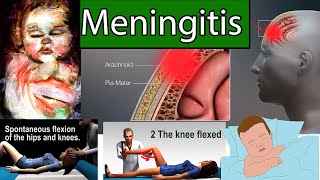 Meningitis in Children  Most Deadly infection for Children [upl. by Gnahc401]