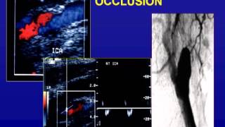 Ultrasound of the Carotid Arteries [upl. by Maurise]