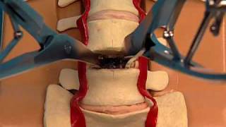 ProDisc Lumbar Total Disc Replacement Saw Bones Technique Video [upl. by Devan]