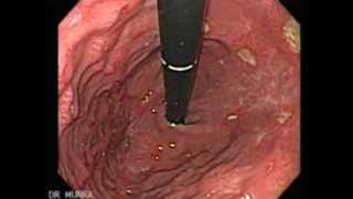 Endoscopy of Multiple Ulcers of the Stomach [upl. by Chem]