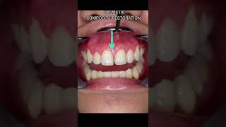 Immediate Fix for GAPS OR SPACES for your front teeth DIASTEMA CLOSURECOSMETIC RESTORATION shorts [upl. by Litnahs]