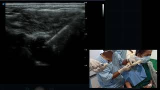 USG guided Shoulder Injection  Ultrasound guided spiration of subcoracoid bursa [upl. by Teahan]