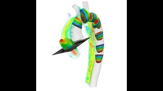 CARDIOVASCULAR BIOMECHANICS  Analyse et traitement numéricoexpérimental de la dissection aortique [upl. by Holman51]