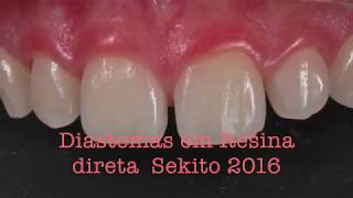 Fechamento de diastema em Resina Composta 2016  SEKITO [upl. by Cochran398]