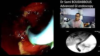 ERCP for pancreatic cancer [upl. by Nayab]