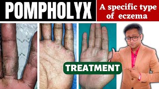 Dyshidrotic eczema  Pompholyx  Treatment  Hindi [upl. by Laumas]