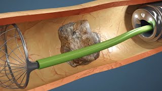 A Surpreendente Evolução Da Cirurgia de Pedra Nos Rins [upl. by Tull]