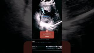 Liver abscessHepatic abscess ultrasound usg liverabscess trending subscribe ultrasoundtherapy [upl. by Rape]