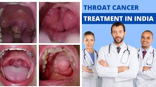 Throat Cancer Treatment in India Throat Cancer Treatment Cost in India [upl. by Eiralih]