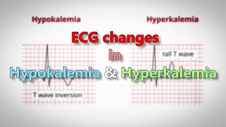 Hypokalemia and Hyperkalemia ECG changes [upl. by Ynohtnaeoj]