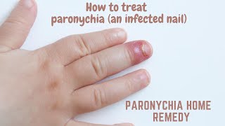 Paronychia home remedy  How to treat paronychia an infected nail [upl. by Mack346]