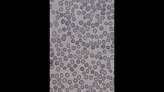 فيديو يوضح خلايا الدم الحمراء المشوكة crenated red blood cells [upl. by Arenat276]