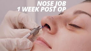 Rhinoplasty Vlog Part 2  Splint Removal and Nose Job Recovery 1 WEEK POST OP [upl. by Nauqan572]