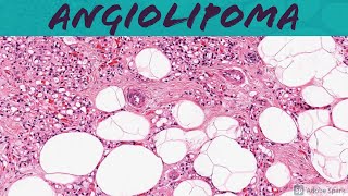 Angiolipoma 5Minute Pathology Pearls [upl. by Pryce757]