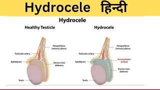 Hydrocele मे पानी भर गया हैँ  सूजन हैँ  Cause  Symptoms  Treatment  Hindi [upl. by Nas]