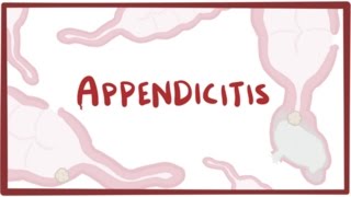 Appendicitis  causes symptoms diagnosis treatment amp pathology [upl. by Atalayah992]