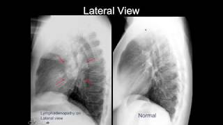 Chest Xray Cases 2 [upl. by Spragens]