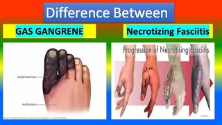 Difference Between GAS GANGRENE and NECROTIZING FASCIITIS [upl. by Mettah448]