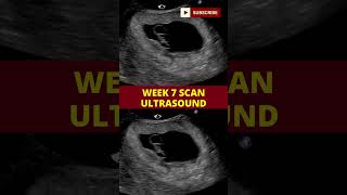 ultrasound scan week 7  pregnancy scan  week by week pregnancy [upl. by Fionna]