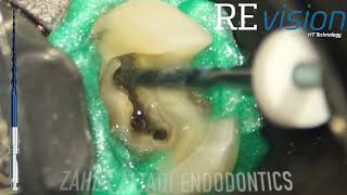 Endodontic case done by Dr Zaher AlTaqi using Endostar REvision [upl. by Lobell728]