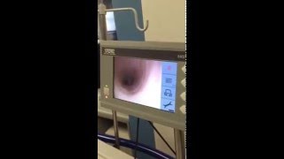 Flexible endoscopic selfintubation [upl. by Annelak110]