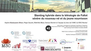 Stenting hybride dans la tétralogie de Fallot [upl. by Adnalue]