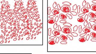 PATHOLOGY SLIDES 7 DR SAMEH GHAZY [upl. by Olrac53]