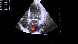 clear view of ischemic dilated cardiomyopathy with MR [upl. by Assenahs]