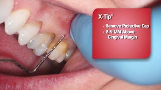 XTIP Intraosseous Anesthetic Delivery System [upl. by Relyt756]