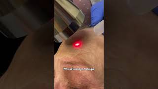 Fully Ablative Erbium Laser Demonstration For Skin Resurfacing and Skin Tightening 🙌 [upl. by Erised]