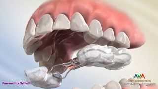 Orthodontic Expander or Spacer  Bonded RPE Appliance [upl. by Omissam]