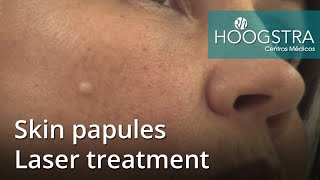 Skin papules  Laser treatment 21023 [upl. by Adlig388]