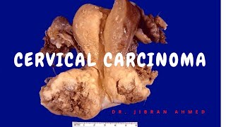 CERVICAL CARCINOMA II FGT II ROBBINS 10TH E II PATHOLOGY LECTURES [upl. by Faun762]