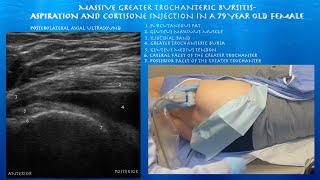 Ultrasound Guided Massive Greater Trochanteric Bursitis Aspiration and Injection by probeultrasound [upl. by Ultun557]