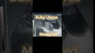 Bulky Uterus  Heterogenous Variable Texture of Uterus  Ovarian Cysts  Adnexa Cyst on Ultrasound [upl. by Eckart]