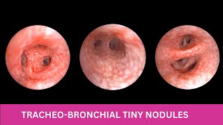 TRACHEOBRONCHIAL NODULES  Cobblestone Appearance [upl. by Darcia926]