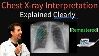 Chest X Ray Interpretation Explained Clearly  How to read a chest Xray [upl. by Giarla]