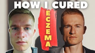 HOW I CURED ECZEMA  My story of full recovery from seborrheic dermatitis on face [upl. by Frederic]