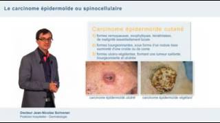 Diagnostic des cancers cutanés  carcinome épidermoïde  basocellulaire et mélanome [upl. by Niffirg]