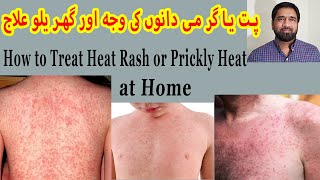 Prickly Heat Treatment  Skin Rash  Red Skin Rash  Miliaria Rubra  Itchy Rash  Sun Allergy [upl. by Kire]