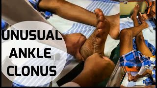 Unusual ANKLE CLONUS An interesting observation on eliciting Chaddocks Schaeffers Bings sign [upl. by Eiliab]