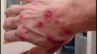 The Morgellons Lesion [upl. by Annay171]