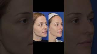 Sculptra Before amp After [upl. by Munroe]