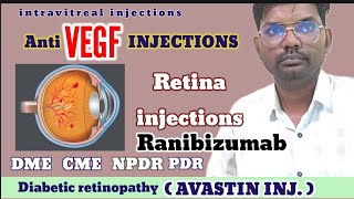 Anti vegf injections  avastin injections  Ranibizumab injections  Bevacizumab injections  vegf [upl. by Soma474]