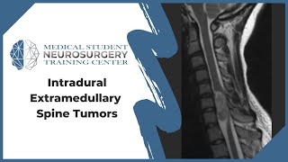 Intradural Extramedullary Spine Tumors [upl. by Blackmore119]