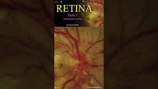 Retinopatía Hipertensiva hipertensión hipertension hipertensionarterial hipertensiónarterial [upl. by Aggarwal482]