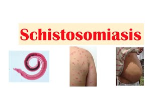 Schistosomiasis  Bilharziasis  Causes Symptoms and Treatment [upl. by Nodnrb]