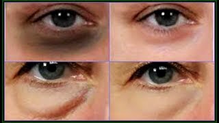 BAKING SODA AND CUCUMBER REMOVE DARK CIRCLES PUFFY EYES AND EYES BAGS Live DemoKhichi Beauty [upl. by Nednarb896]