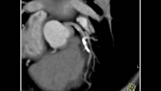 Vascular LAD stenosis 3D and 4D mapping demonstrates extensive calcification3 of 4 [upl. by Rexford889]